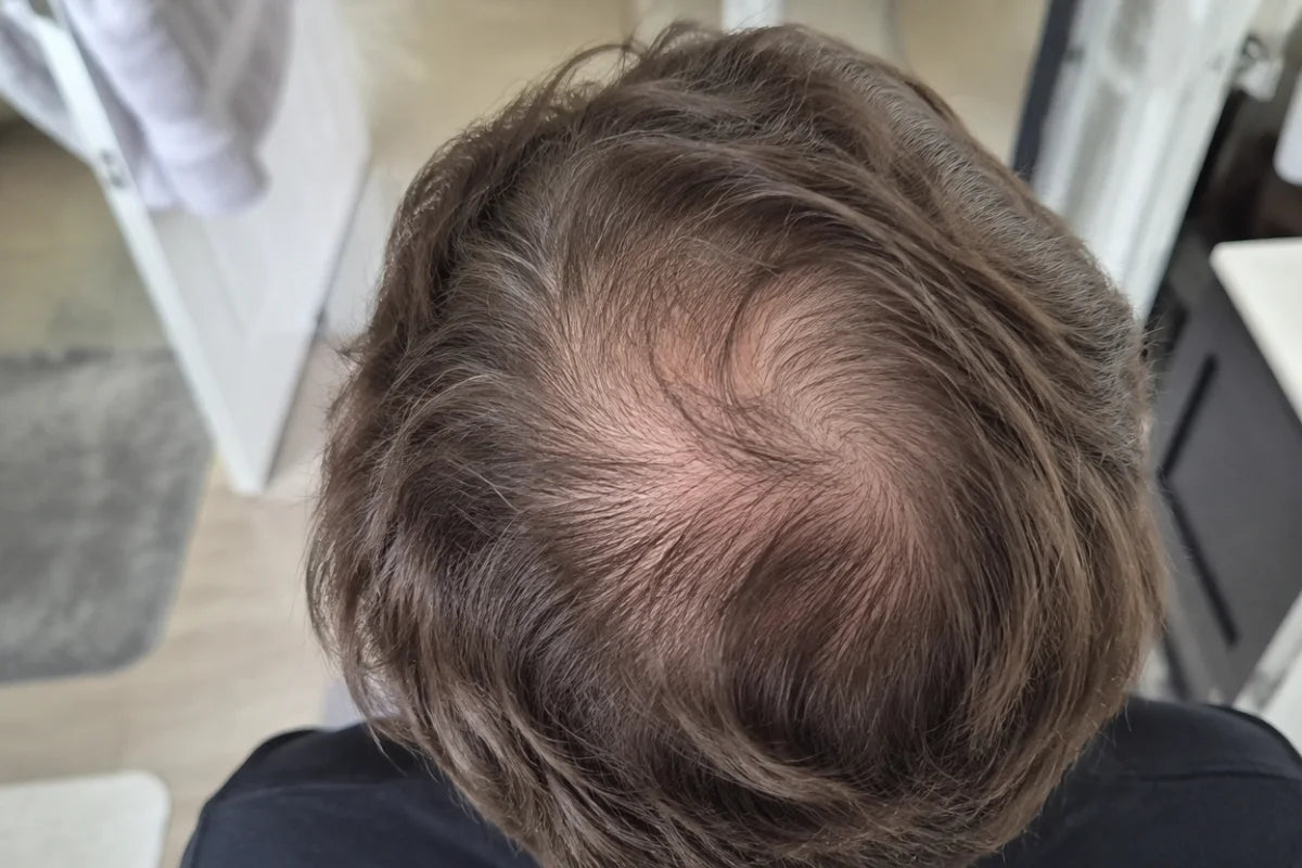 A phone photo of the top of a head where the crown is thinning