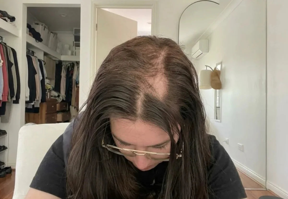 A phone photo of a woman looking down, her parting showing scalp